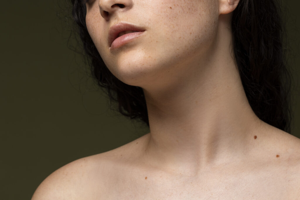 Melasma On Neck