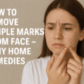 How To Remove Pimple Marks From Face
